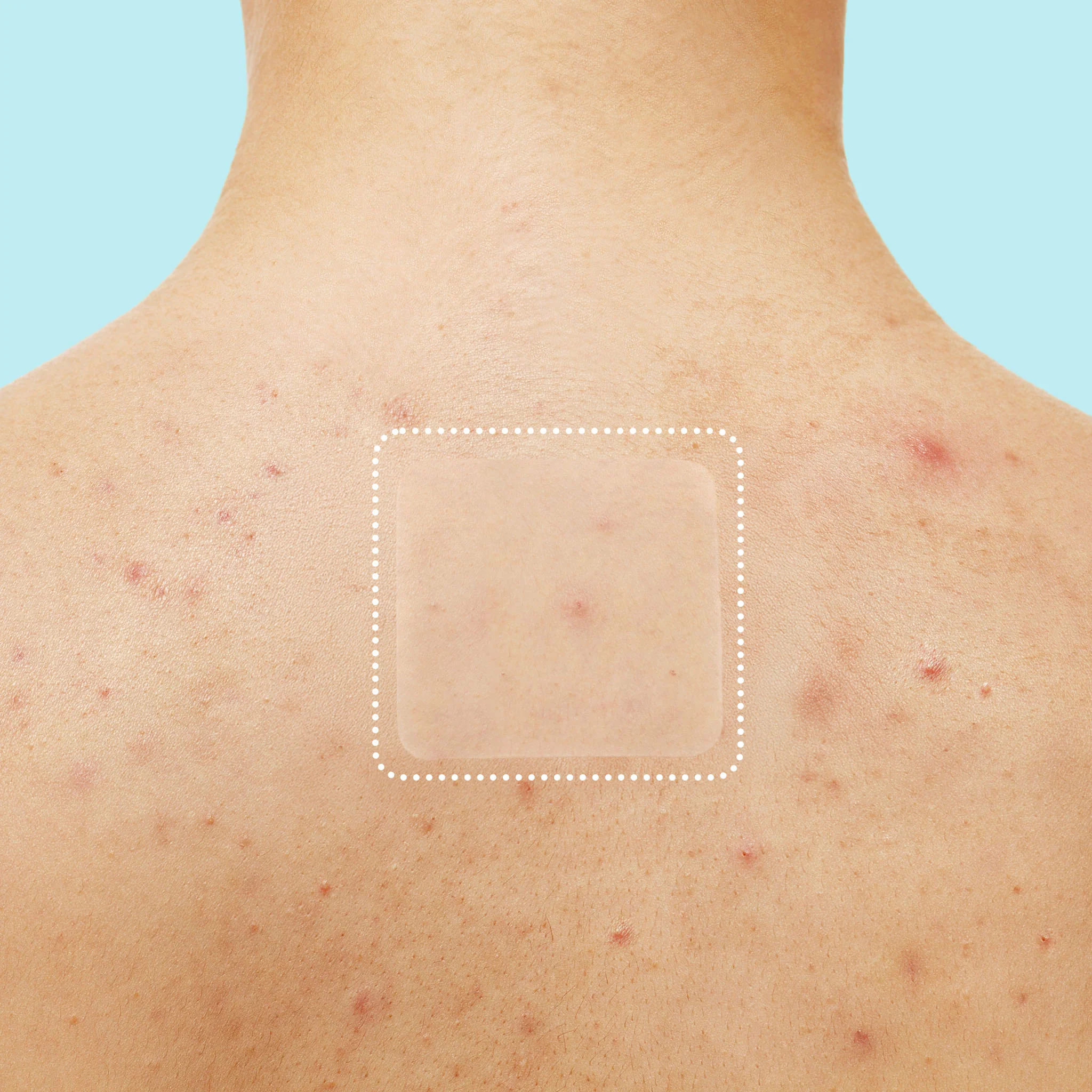 Miracle Patch XL Spot Control Cover - Image 4